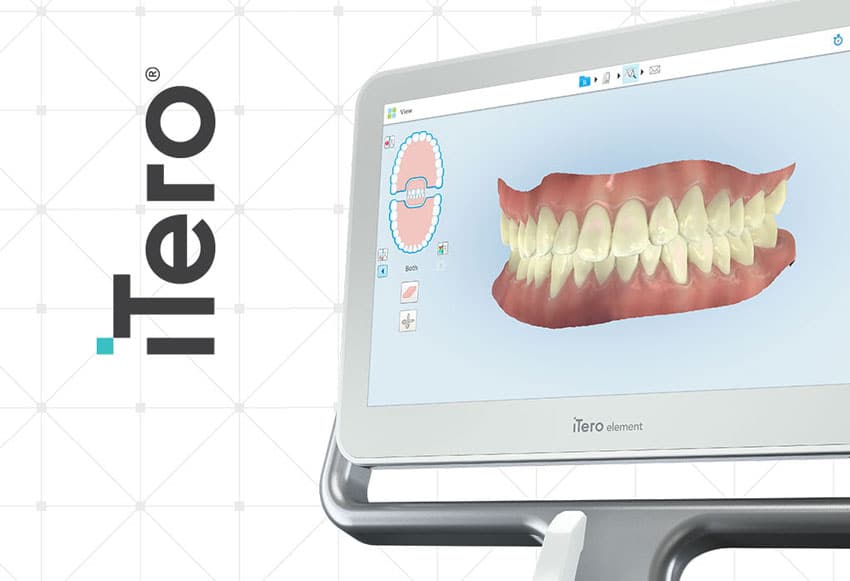 Itreo, technology used for dental impressions