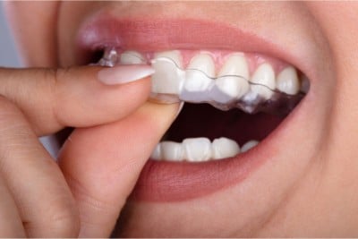 CandidPro® Orthodontics being placed on upper teeth securly 